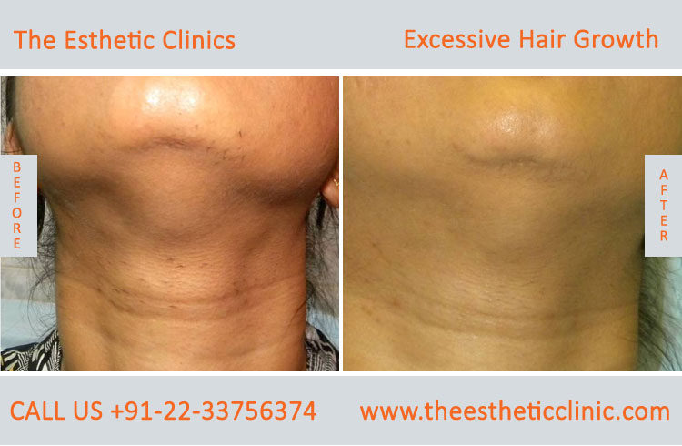Excessive Hair Growth Removal Treatment before after photos in mumbai india (10)